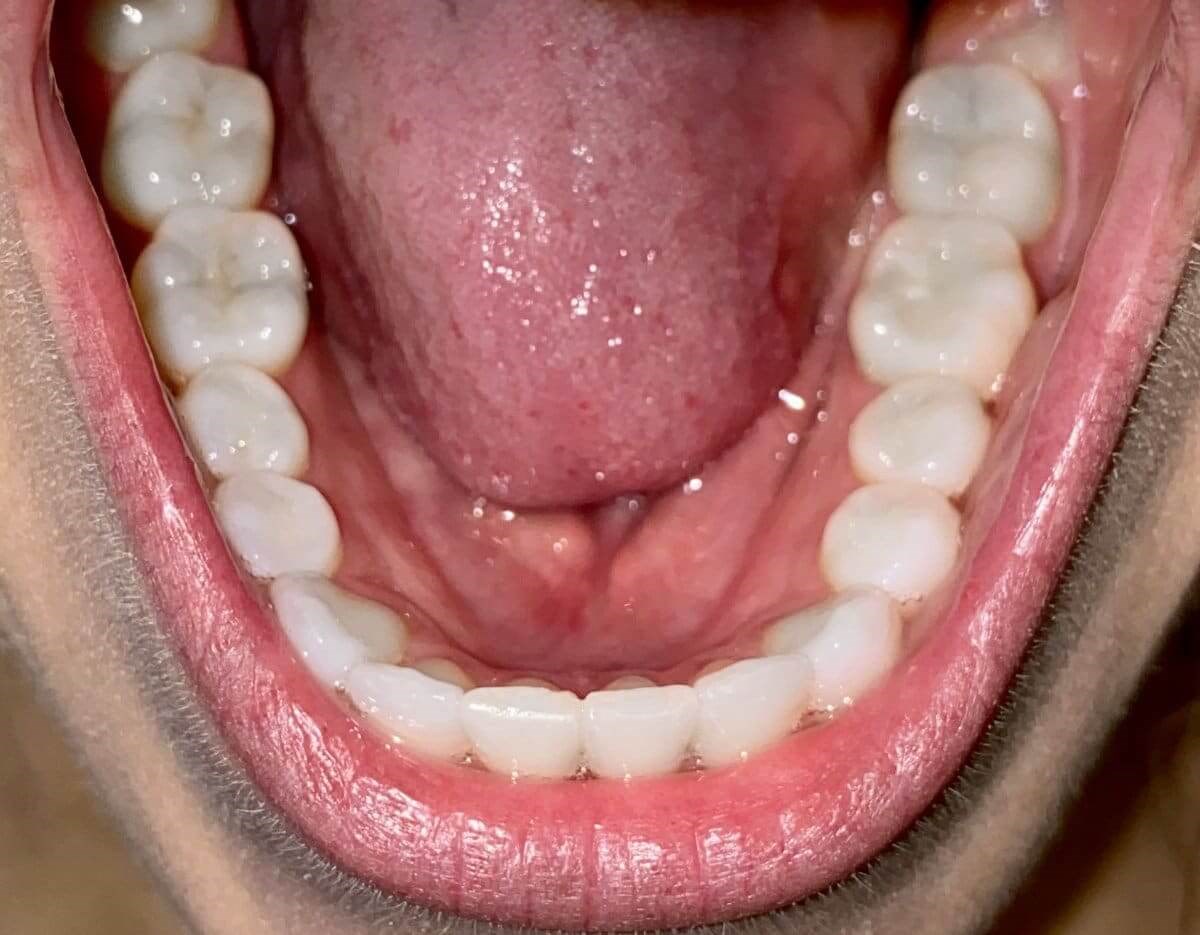 Upper Teeth