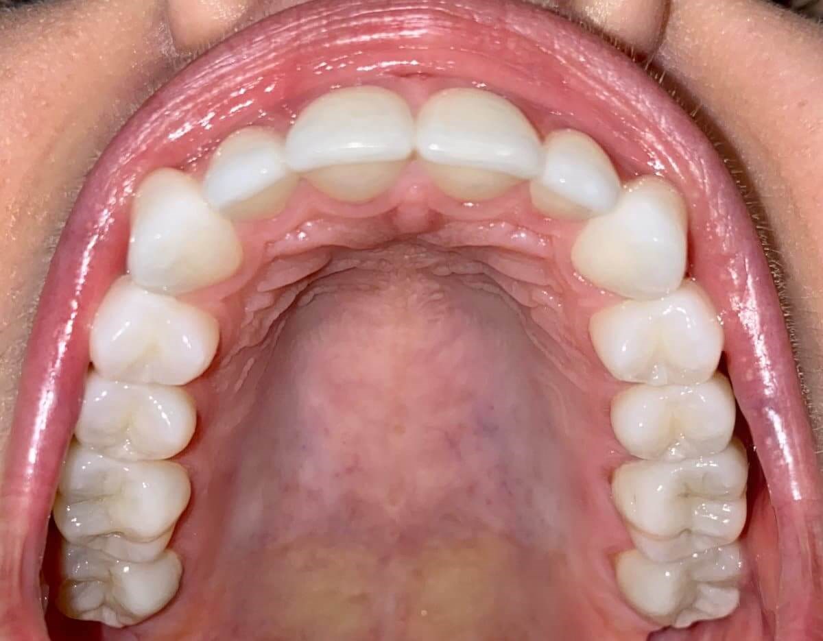 Lower Teeth